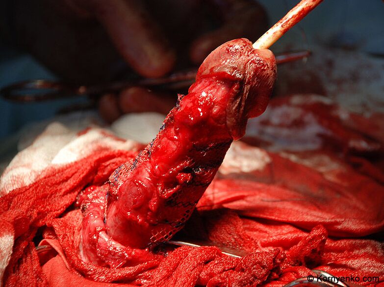 instalación de una matriz de colágeno para agrandar el pene