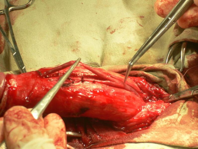 lipofilling del pene para agrandar