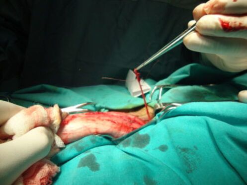 cirugia de agrandamiento del pene