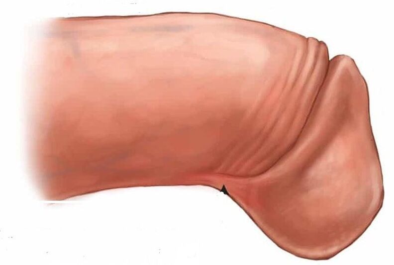 cómo agrandar el glande del pene