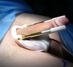 ¿Cómo se realiza la cirugía de agrandamiento del pene